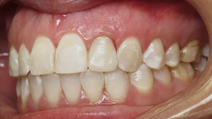 Des chercheurs annoncent avoir trouvé une méthode révolutionnaire pour régénérer l'émail dentaire 4 1762893764 875 Des chercheurs annoncent avoir trouve une methode revolutionnaire pour regenerer.webp