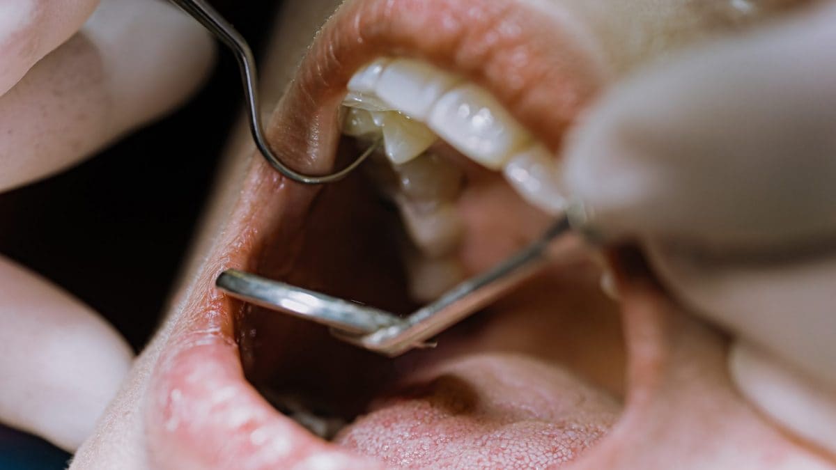 La dévitalisation des dents pourrait préserver votre cœur, votre cerveau et votre santé, selon une étude 2 Image
