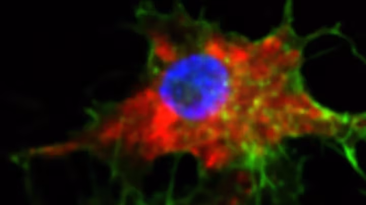 Nouveau médicament lutte contre le cancer 20 000 fois plus efficacement et sans effets secondaires 2 Image cellules du cancer du sang