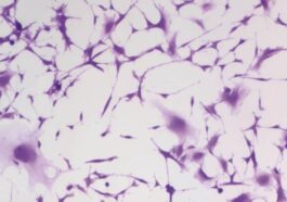 Les cellules du glioblastome bloquées par l'hydralazine, un médicament courant contre l'hypertension. Crédit : Kyosuke Shishikura