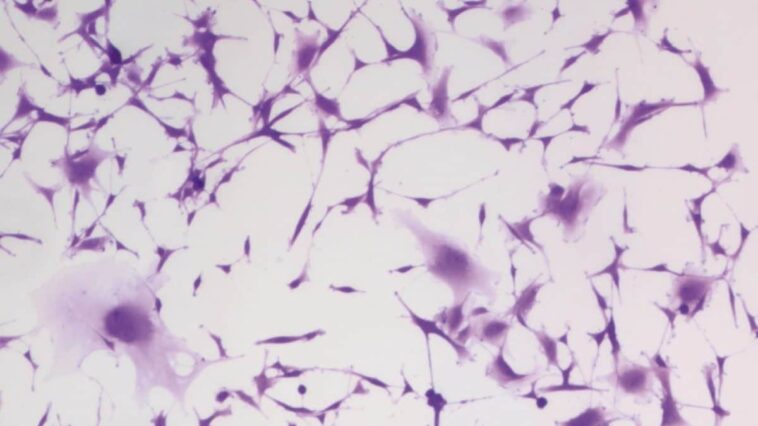 Un médicament courant contre l'hypertension stoppent les cellules d'un cancer cérébral mortel : une découverte fascinante 1 Les cellules du glioblastome bloquées par l'hydralazine, un médicament courant contre l'hypertension. Crédit : Kyosuke Shishikura