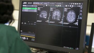 Deux nouveaux sous-types de sclérose en plaques identifiés grâce à l'intelligence artificielle 29 Images de résonance magnétique cérébrale analysées avec des outils d'intelligence artificielle dans l'étude publiée sur Brain / Crédit: MS Society