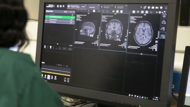 Deux nouveaux sous-types de sclérose en plaques identifiés grâce à l'intelligence artificielle 1 Images de résonance magnétique cérébrale analysées avec des outils d'intelligence artificielle dans l'étude publiée sur Brain / Crédit: MS Society