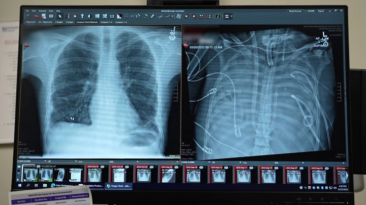 Un patient a survécu 48 heures sans poumons en attendant une greffe 3 Radiographies montrant les nouveaux poumons (à gauche) et les anciens poumons (à droite) du patient de 33 ans.