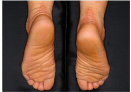 Un patient avec cheratosi palmoplantare de type Nagashima (NPPK). Crédit : N. Ono et al., Journal of Investigative Dermatology
