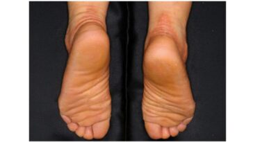 Dévoilez l'origine d'une odeur désagréable des pieds : découvrez enfin comment y remédier 25 Un patient avec cheratosi palmoplantare de type Nagashima (NPPK). Crédit : N. Ono et al., Journal of Investigative Dermatology
