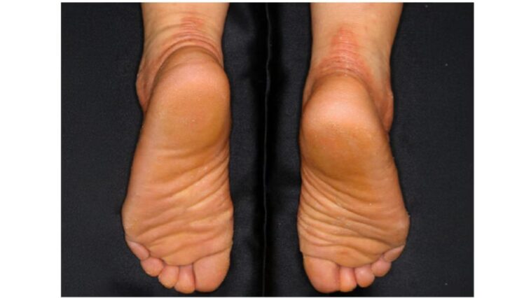 Dévoilez l'origine d'une odeur désagréable des pieds : découvrez enfin comment y remédier 1 Un patient avec cheratosi palmoplantare de type Nagashima (NPPK). Crédit : N. Ono et al., Journal of Investigative Dermatology