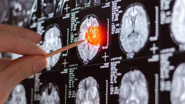 Jusqu'aux racines invisibles de la tumeur, Bello : "Avec notre technique, nous préservons le cerveau sain" 1 Image