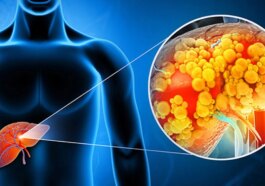 Changements dans les cellules du foie causés par une exposition prolongée à des régimes alimentaires riches en graisses, comme le régime cétogène, pouvant augmenter la vulnérabilité au cancer, selon une nouvelle étude du MIT. Photo : iStock