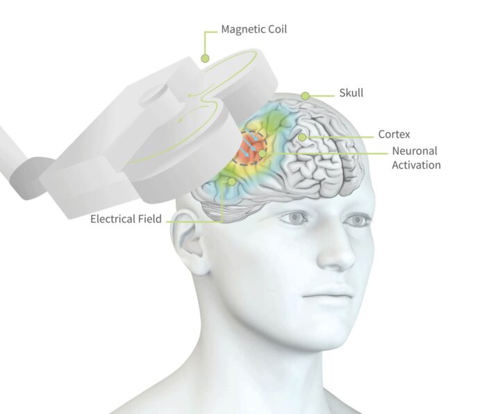 La maladie de Parkinson : bien plus qu'une simple perturbation du mouvement, elle impacte tout un réseau cérébral ! 5 L'équipe a exécuté des tests via une technique non invasive appelée stimulation magnétique transcrânienne (TMS), où les médecins plaçaient une bobine magnétique sur le cuir chevelu, juste au-dessus de la M1.