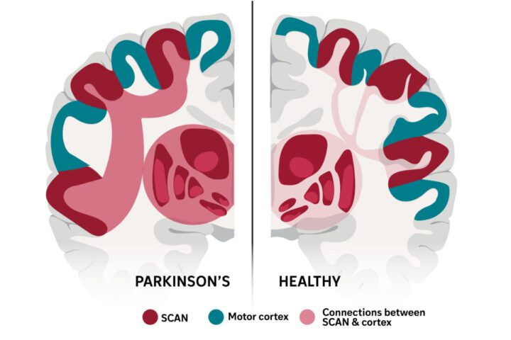 La maladie de Parkinson : bien plus qu'une simple perturbation du mouvement, elle impacte tout un réseau cérébral ! 4 Le réseau cérébral liant pensée et mouvement, appelé SCAN, a été décrit pour la première fois en 2023. Une thérapie expérimentale ciblant ce réseau a plus que doublé les améliorations des symptômes chez un petit groupe de patients parkinsoniens.