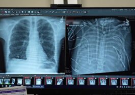 Un jeune survit deux jours sans poumons liquéfiés par une septicémie : découvrez comment ils y sont parvenus 82 À gauche, les poumons transplantés ; à droite, ceux liquéfiés par l'infection. Crédit : Northwestern Medicine
