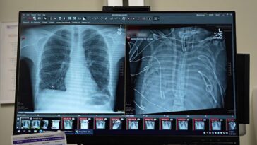 Un jeune survit deux jours sans poumons liquéfiés par une septicémie : découvrez comment ils y sont parvenus 6 À gauche, les poumons transplantés ; à droite, ceux liquéfiés par l'infection. Crédit : Northwestern Medicine