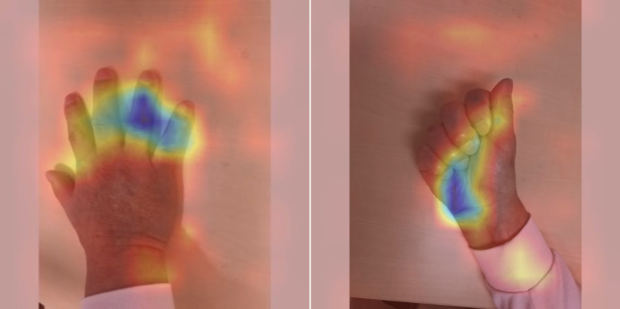 Une simple photo peut aider les médecins à détecter une maladie rare qui fait gonfler les mains et les pieds 3 Cartes d'activation du modèle d'intelligence artificielle soulignant les zones de la main utilisées pour reconnaître les signes d'acromégalie. Crédit : Université de Kobe.