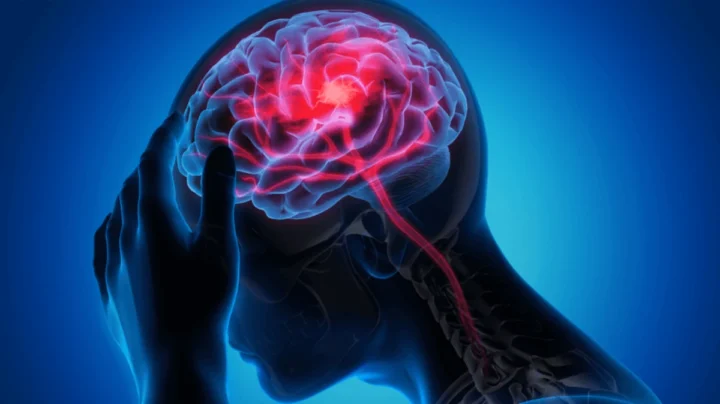 Des scientifiques injectent un fluide magnétique dans le cœur, convaincus de pouvoir prévenir les AVC 3 Illustration des symptômes d'AVC