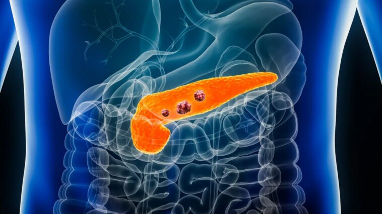 Cancer du pancréas : une étude sur des souris élimine les cellules précancéreuses avant qu'elles ne se transforment en tumeur 1 Image