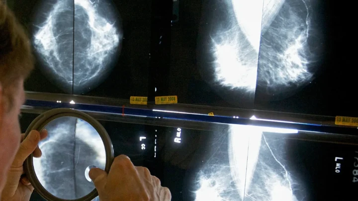 1780656572 387 Espagne 111 cas dun cancer rare lie aux implants