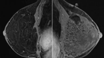 Espagne : 111 cas d’un cancer rare lié aux implants mammaires détectés