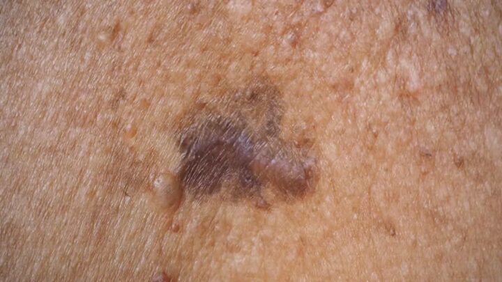 La tendance du bronzage sur les réseaux sociaux inquiète les dermatologues 2 1785616958 864 La tendance du bronzage sur les reseaux sociaux inquiete les