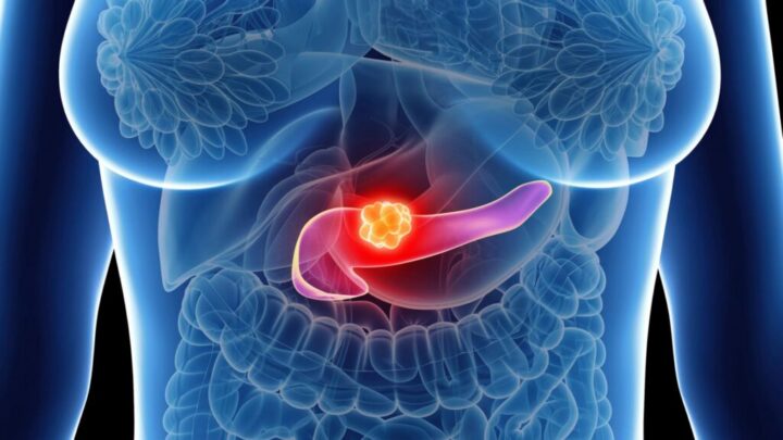Cancer du pancréas : un médicament approuvé aux États-Unis pourrait arriver en Europe dans quelques mois 1 Cancer du pancréas : un médicament approuvé aux États-Unis pourrait arriver en Europe dans quelques mois
