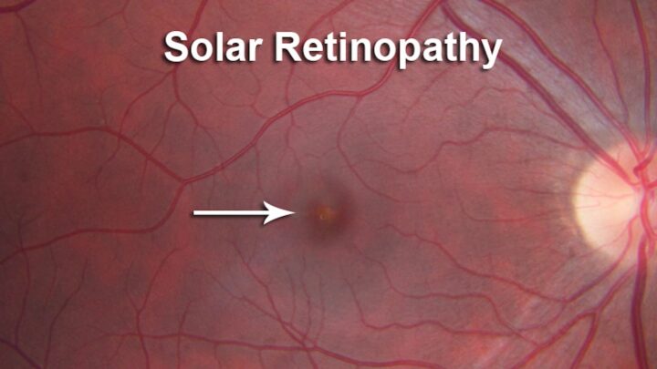 Éclipse solaire : vos yeux sont-ils abîmés ? Les symptômes à ne pas ignorer 2 Retinopatia solar (ou maculopatia solar).