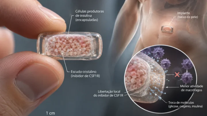 Adieu aux injections d'insuline ? Ce pancréas vivant miniature révolutionne le traitement 3 1789847804 954 Adieu aux injections dinsuline Ce pancreas vivant miniature revolutionne le